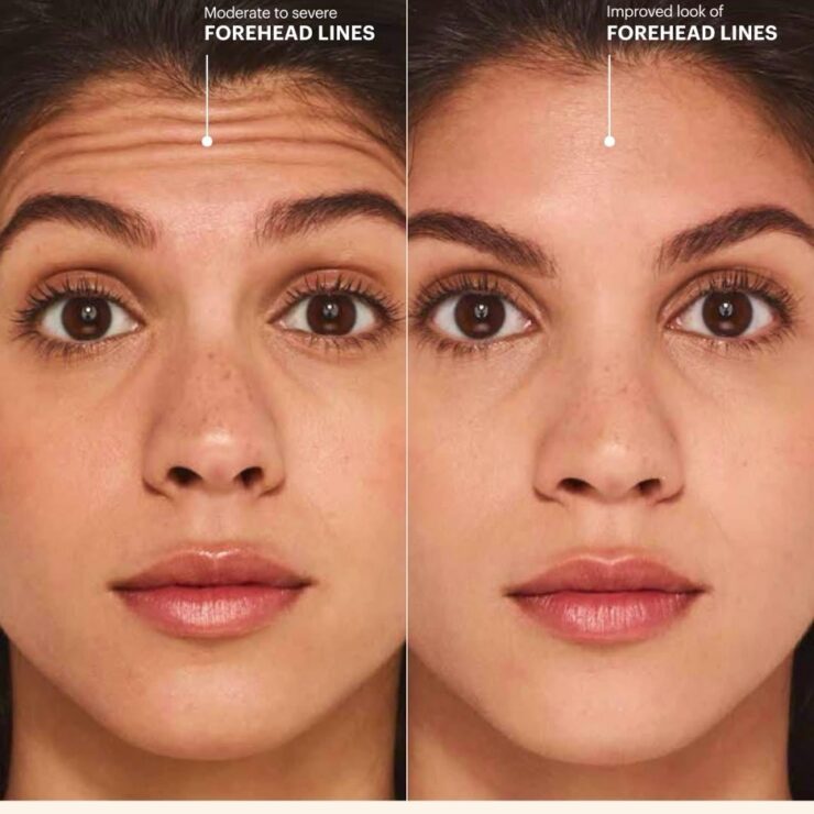 Botox Cosmetic