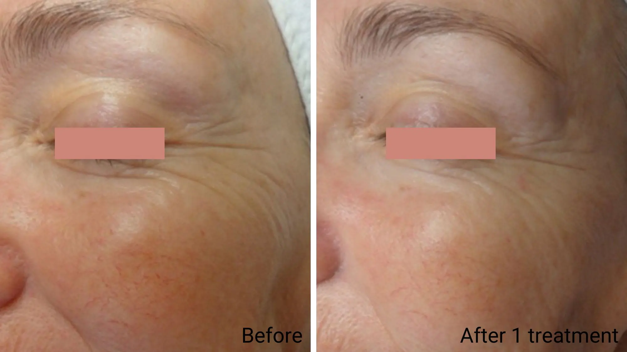 Brightening Facial