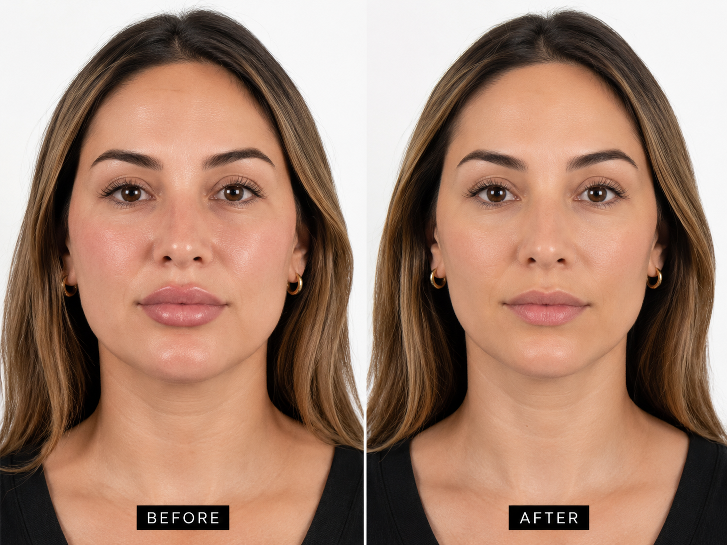 Filler Removal