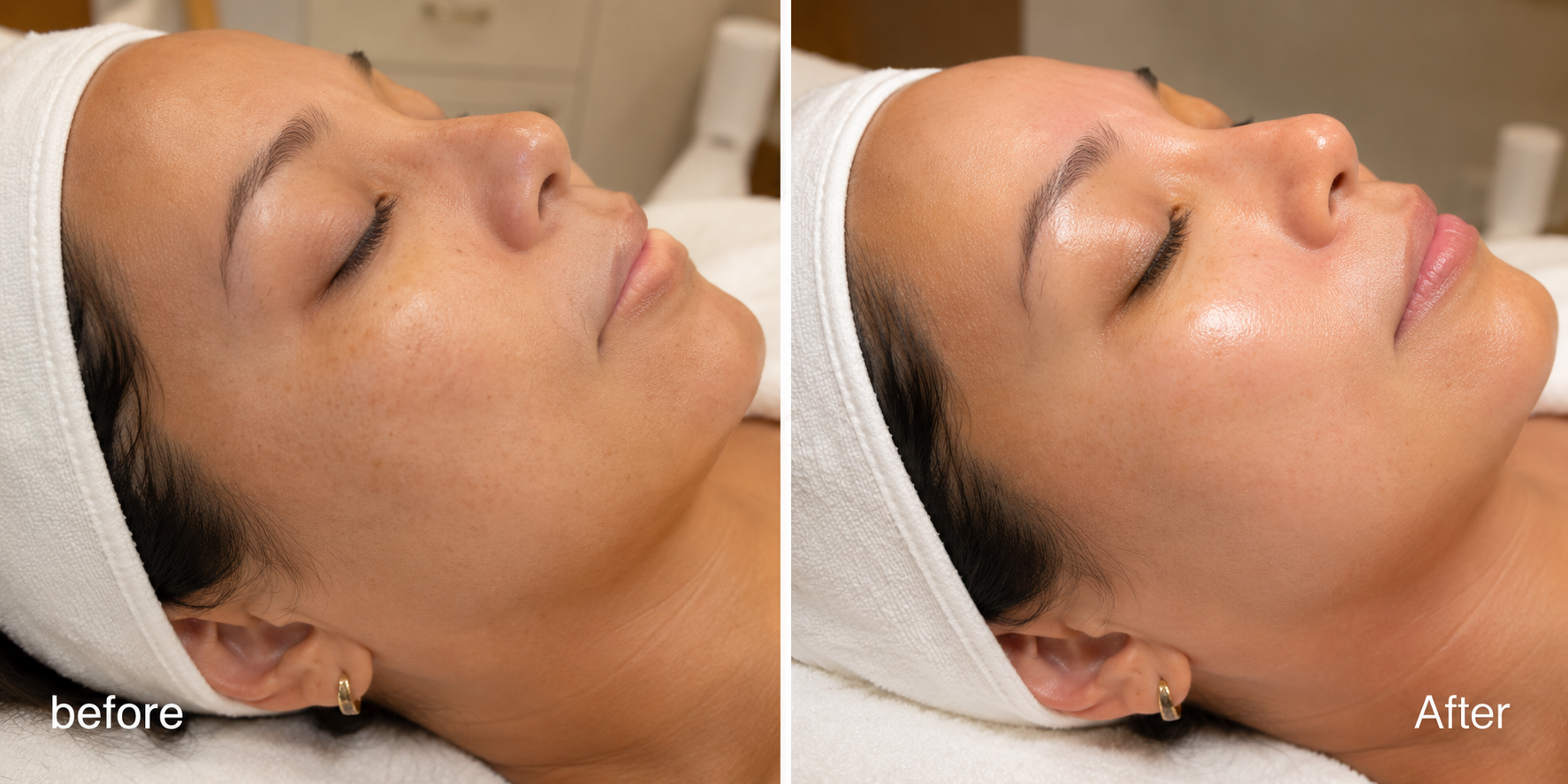 Hydrofacial