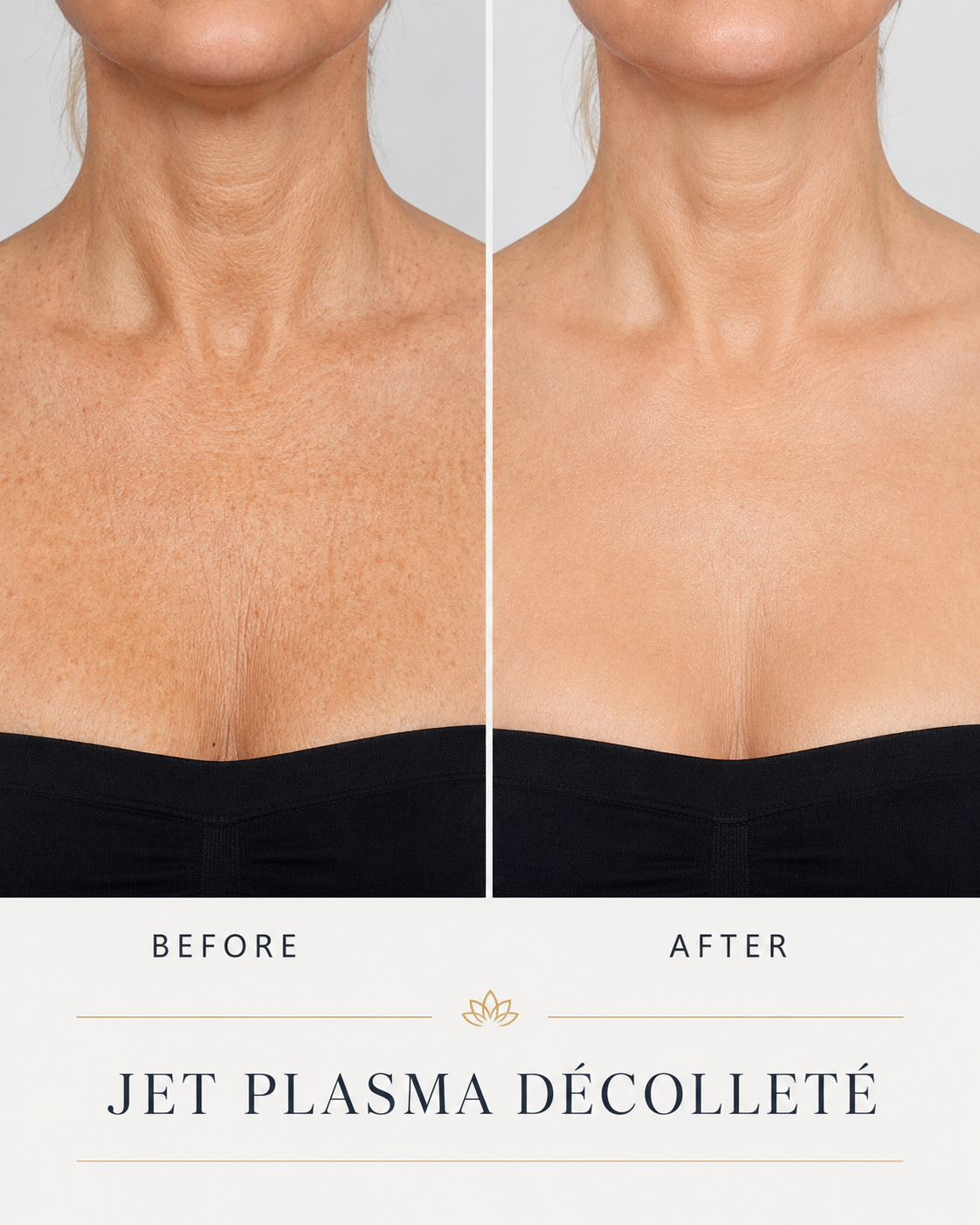 Jet Plasma Décolleté