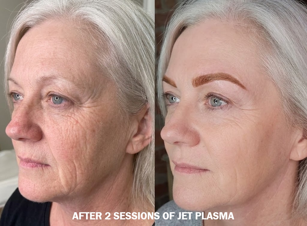 Jet Plasma Face and Neck Treatment