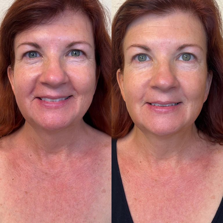 Jet Plasma Undereye