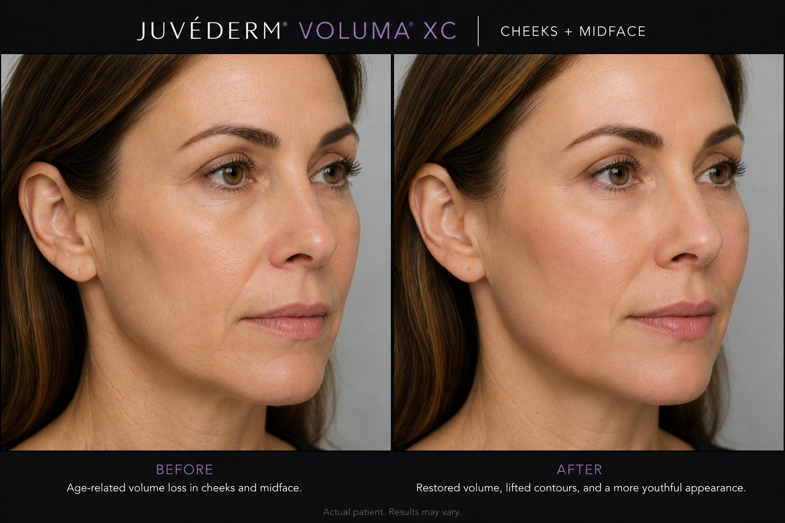Juvederm Voluma