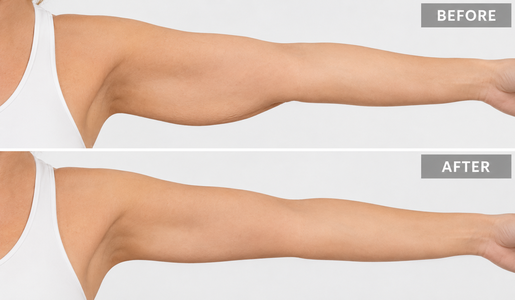 Lipo Sculpt