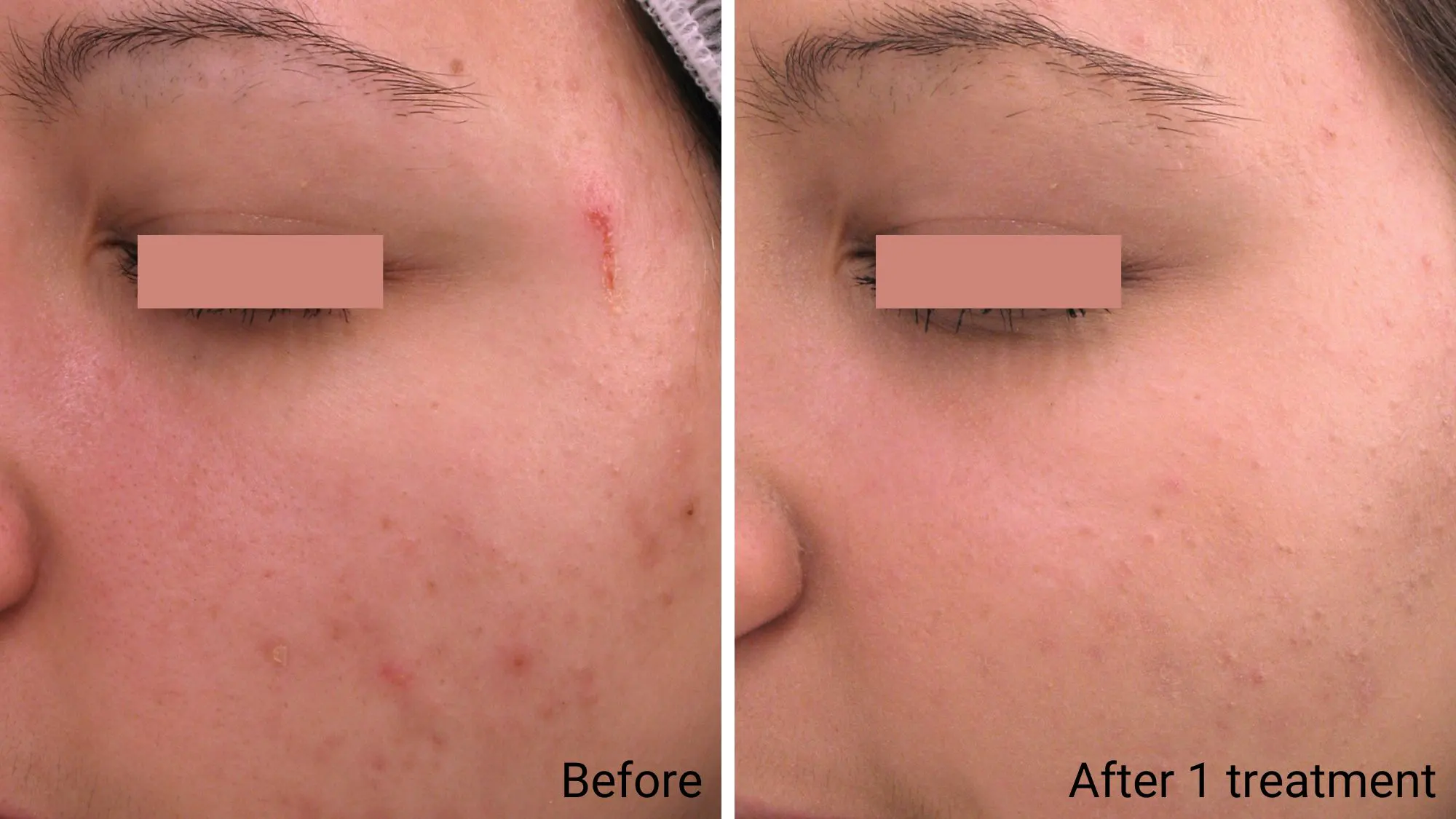 Oxygen Facial