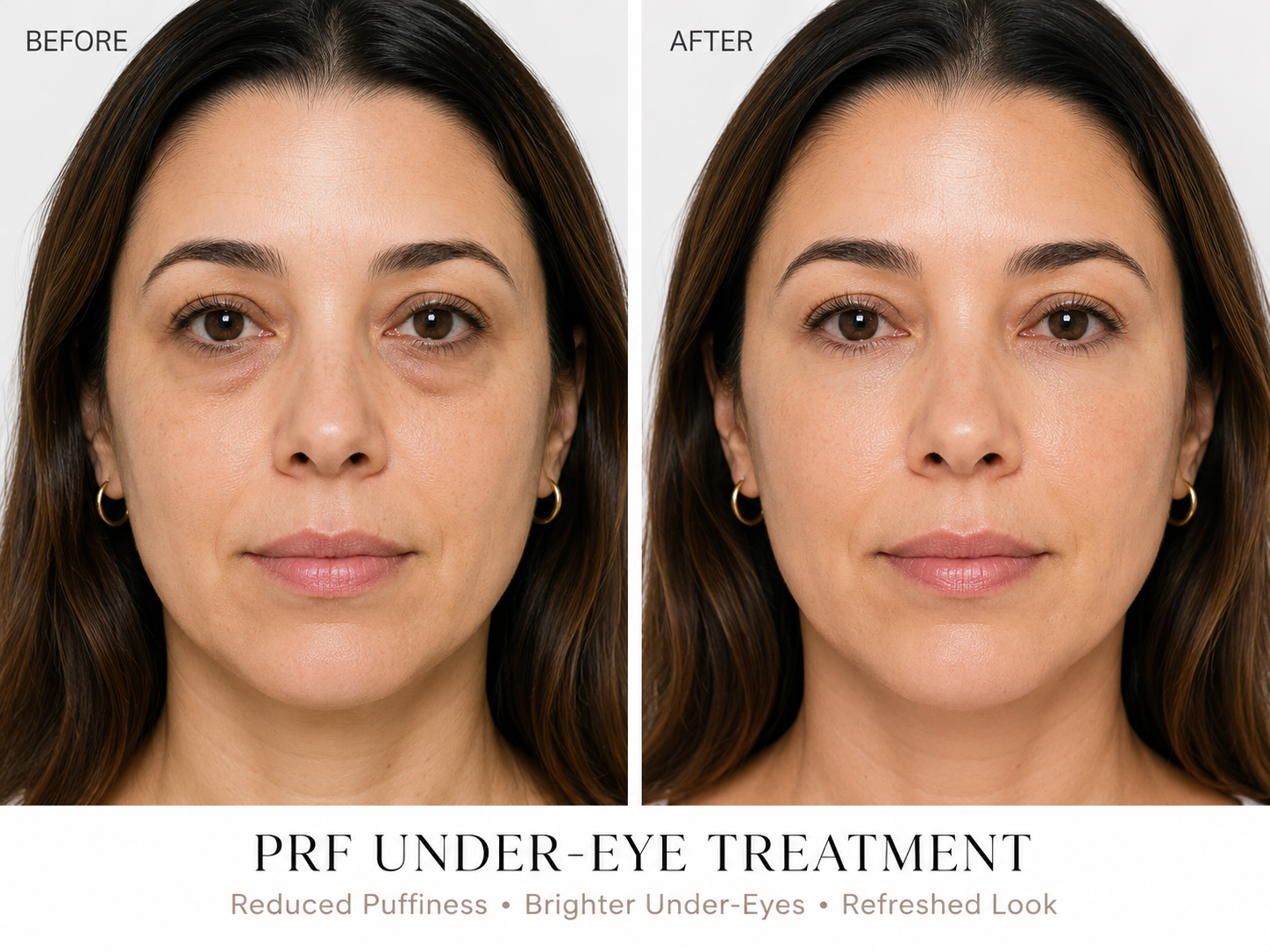 PRF Under Eyes