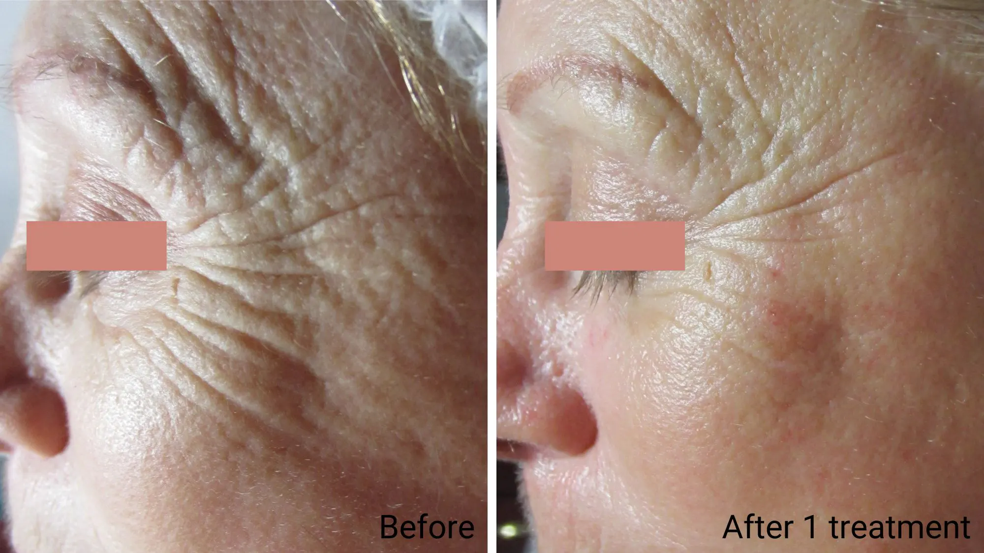 Red Carpet Clinical Facial Signature Anti-Aging
