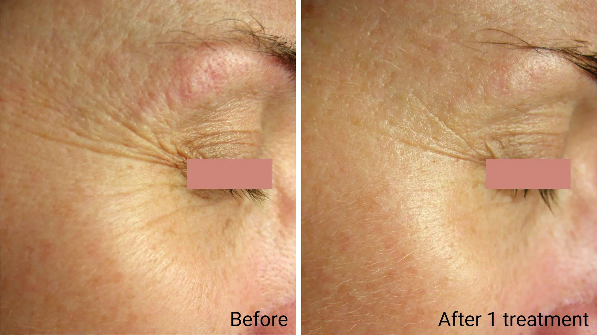 Red Carpet Clinical Facial Powerful Collagen Anti-Wrinkle