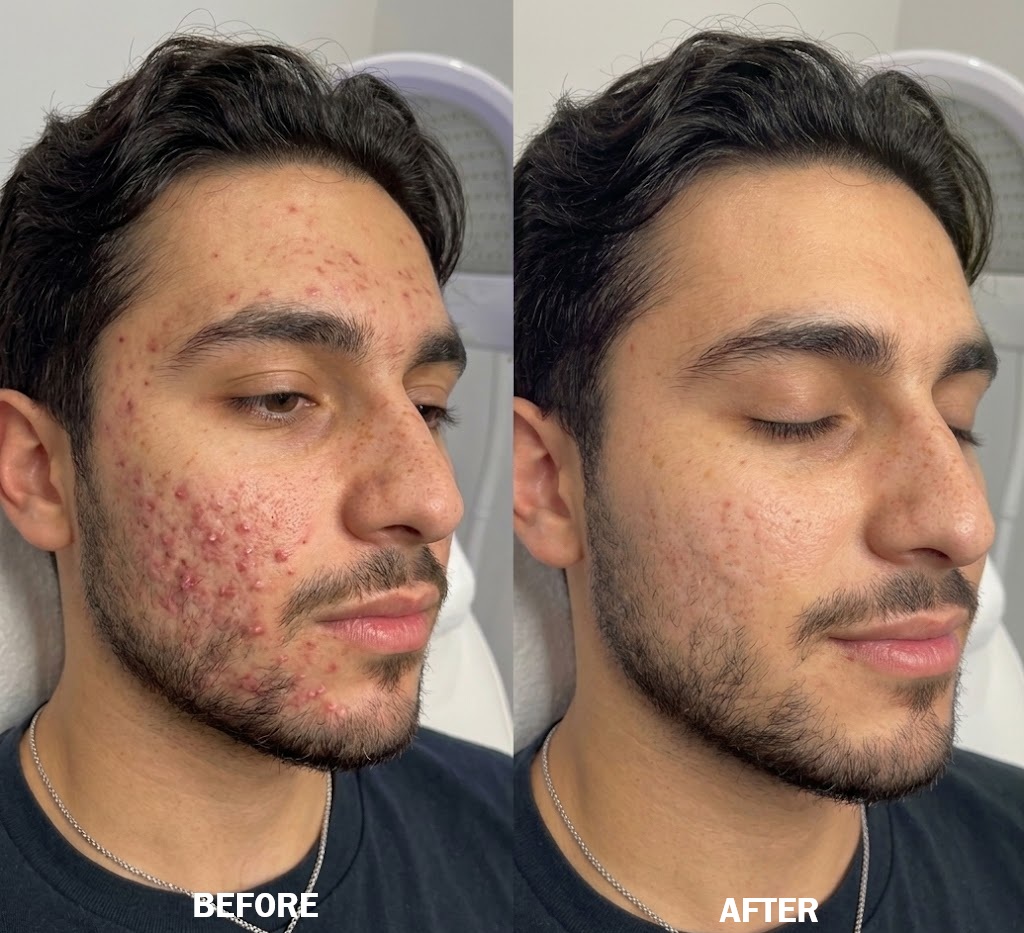 Teen Facial